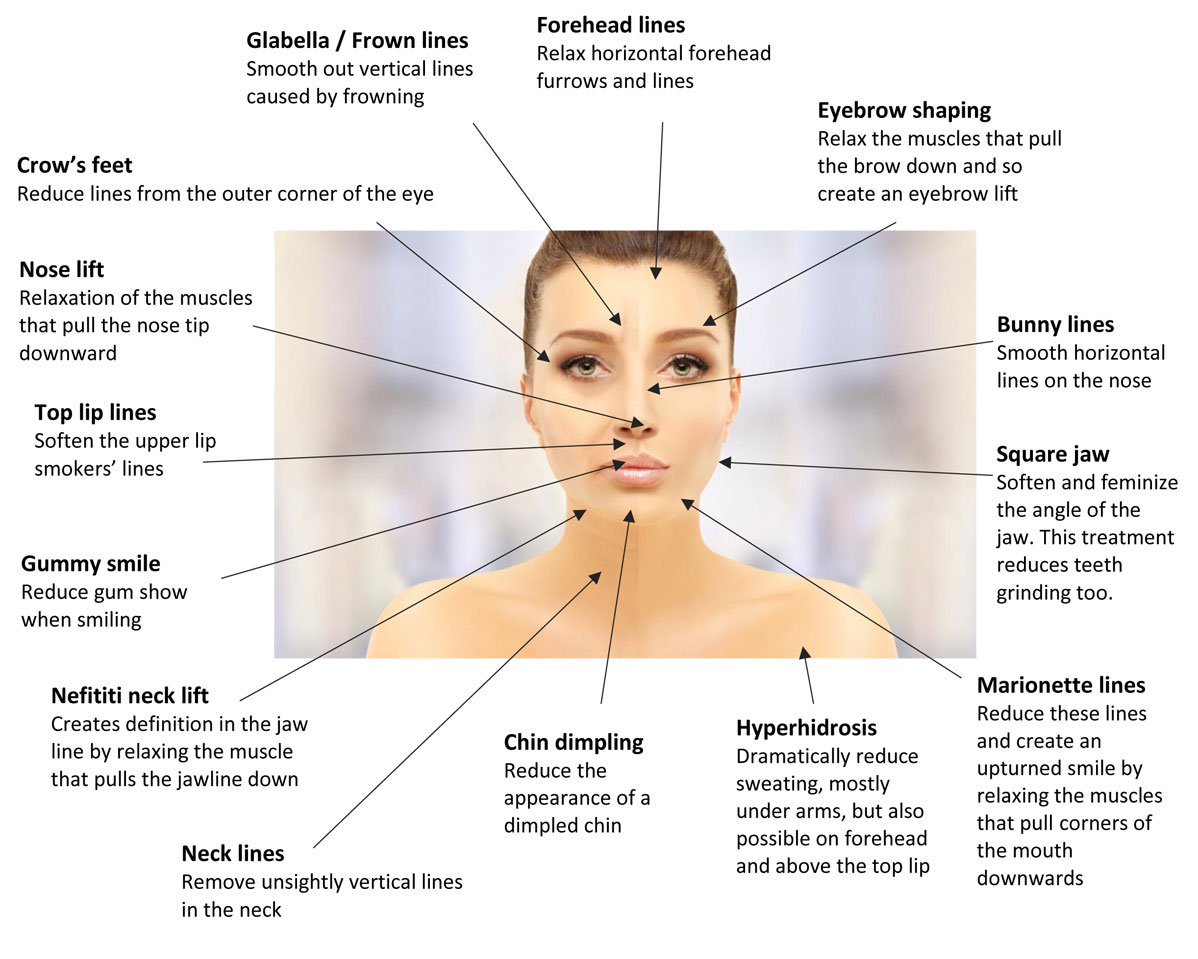 Diagram of areas that Botox can be used to treat