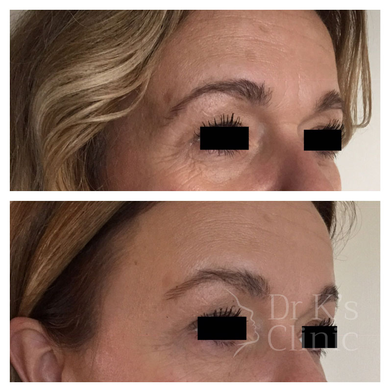 Before and after photo of wrinkle treatment (Botox) in Chester