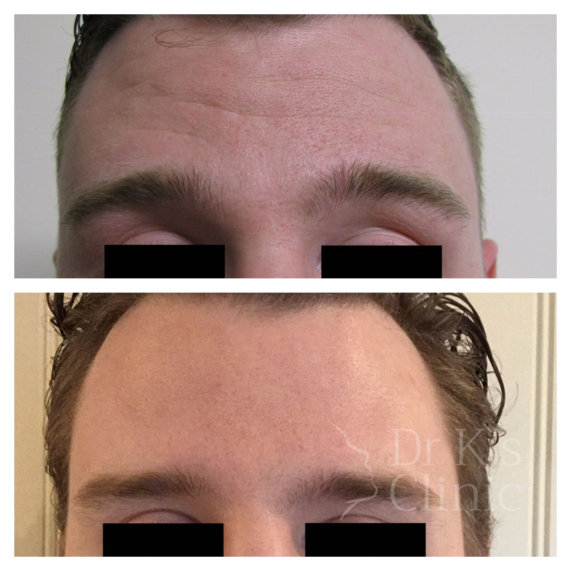Before and after photo of wrinkle treatment (Botox) in Wrexham