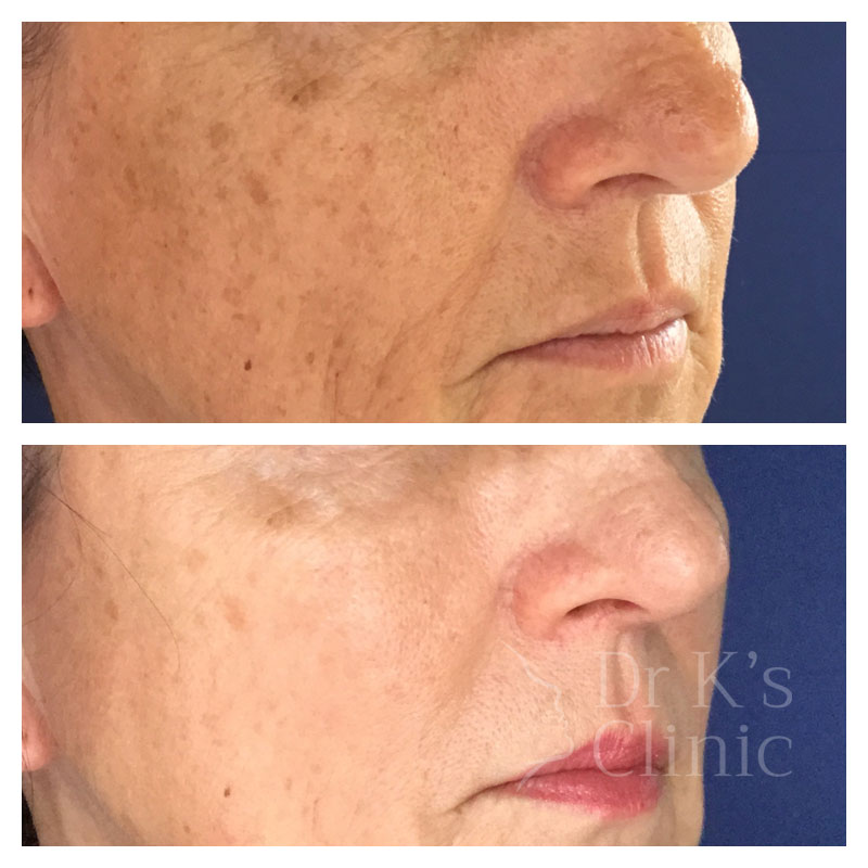Before and after photo of medical grade peels in Chester