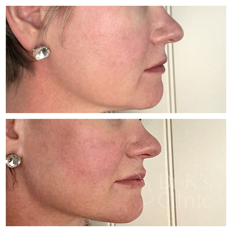 Before and after photo of dermal bio-stimulators in Chester