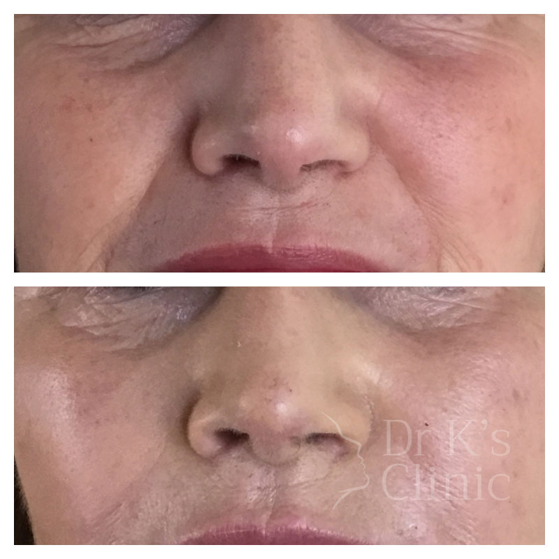 Before and after photo of medical grade peels in Wrexham