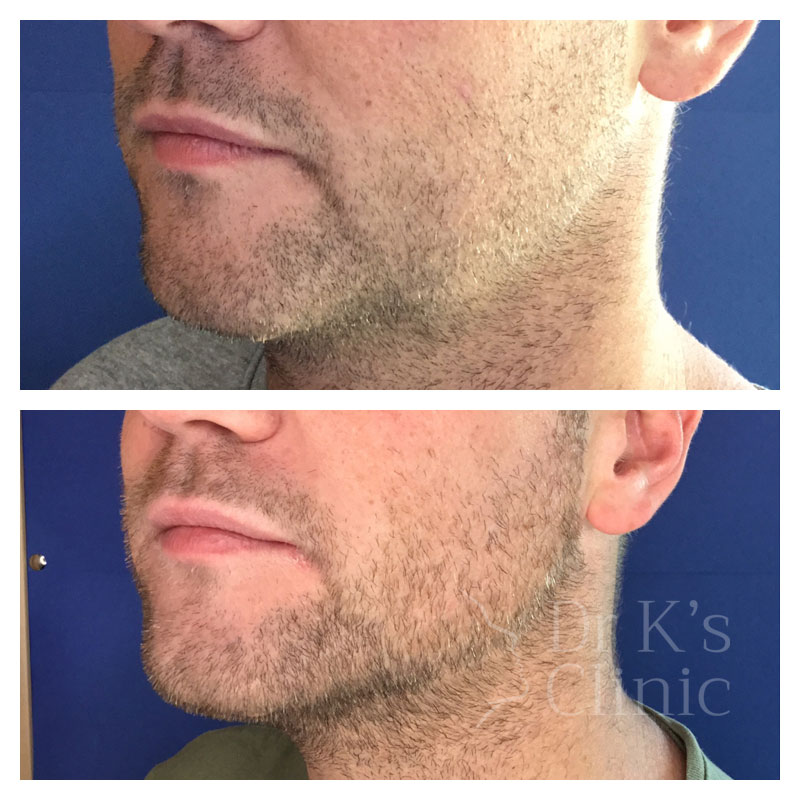 Before and after photo of Aqualyx (double chin reduction) in Wrexham