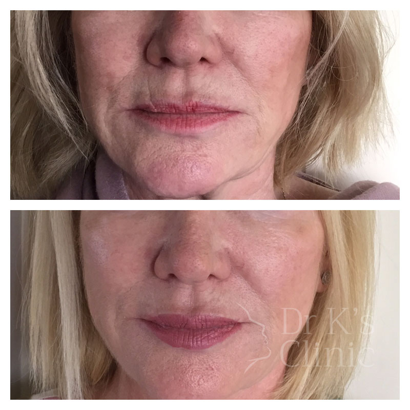 Before and after photo of dermal HA fillers in Wrexham