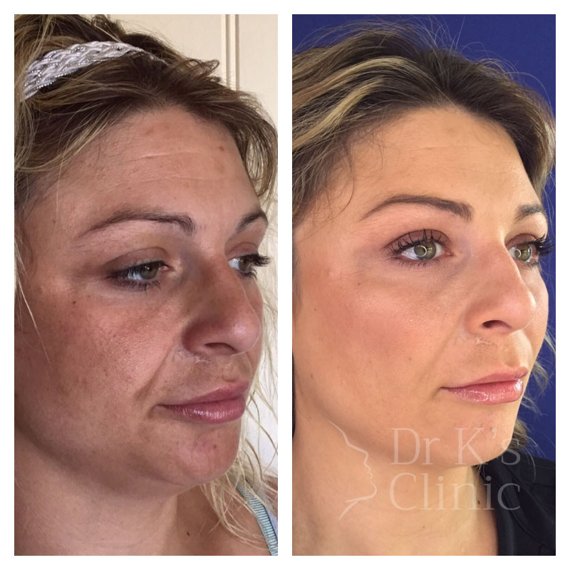 Before and after photo of liquid facelift