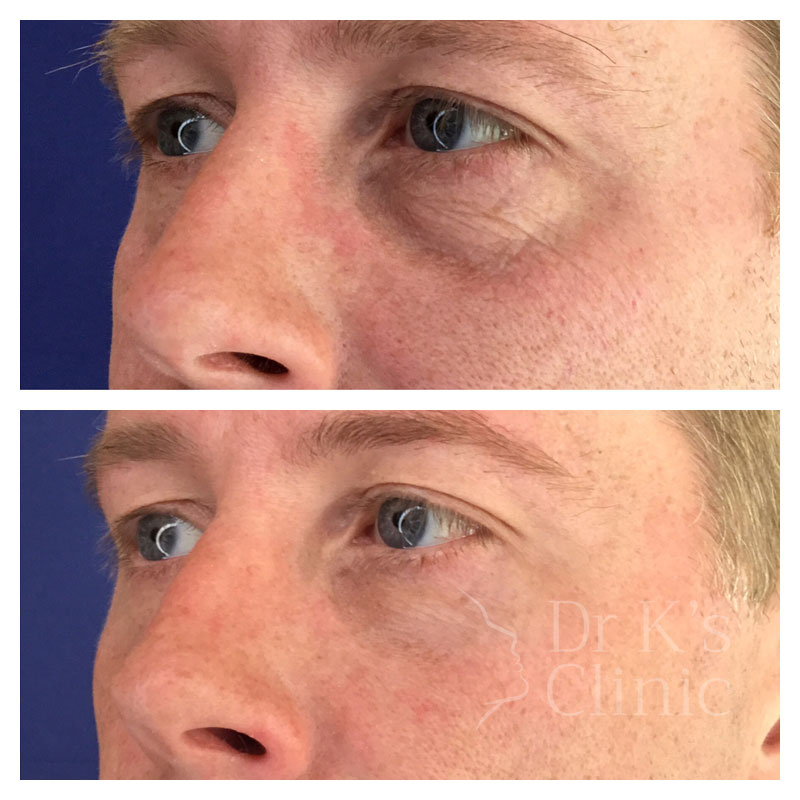 Before and after photo of dermal HA fillers