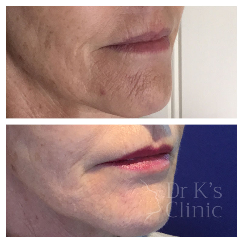 Before and after photo of medical microneedling & mesotherapy