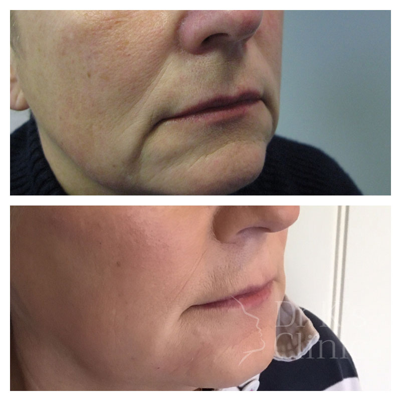 Before and after photo of dermal HA fillers
