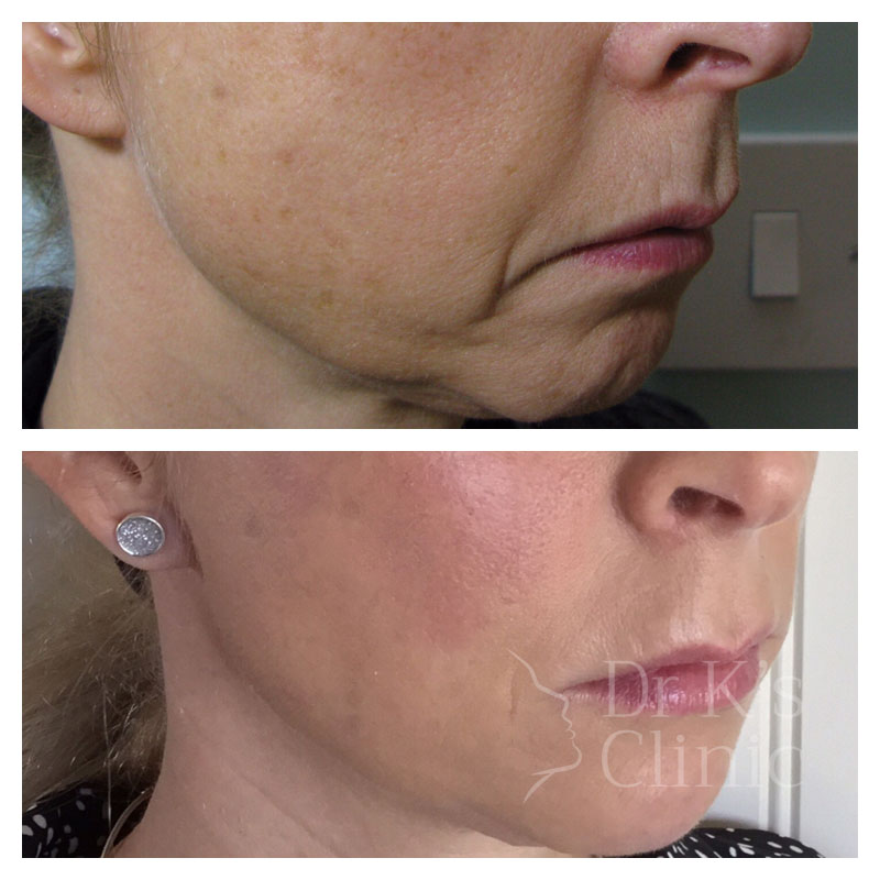 Before and after photo of dermal HA fillers