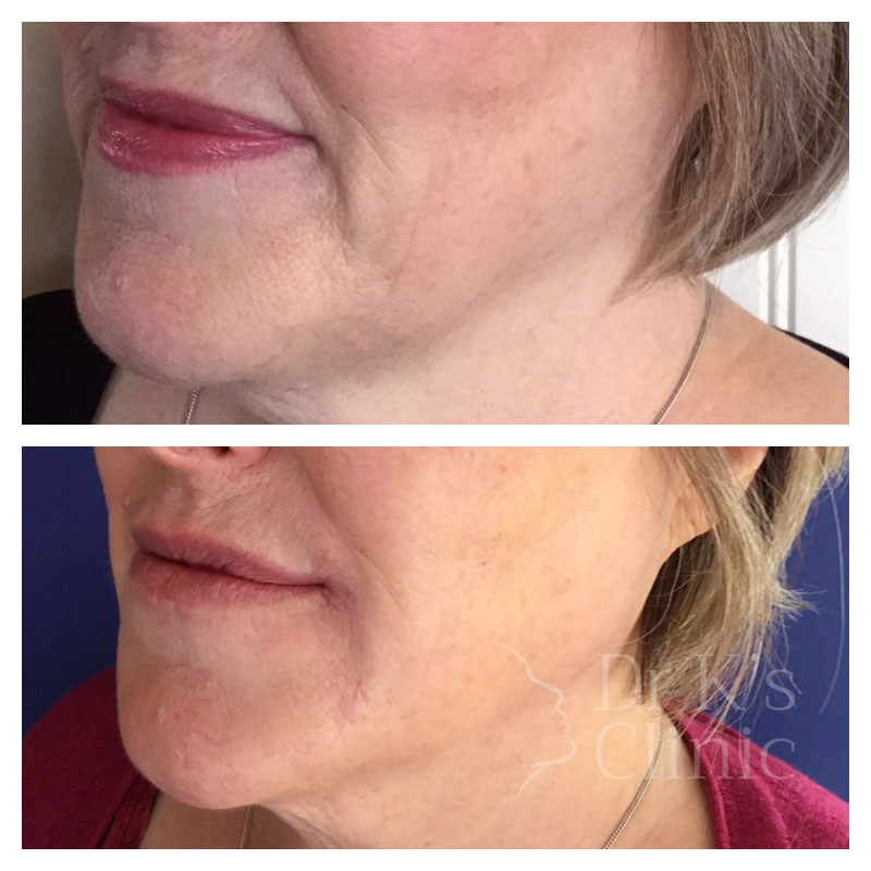 Before and after photo of Aqualyx (double chin reduction) in Chester