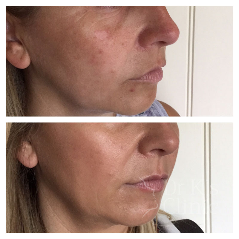 Before and after photo of dermal bio-stimulators & Thread Lift