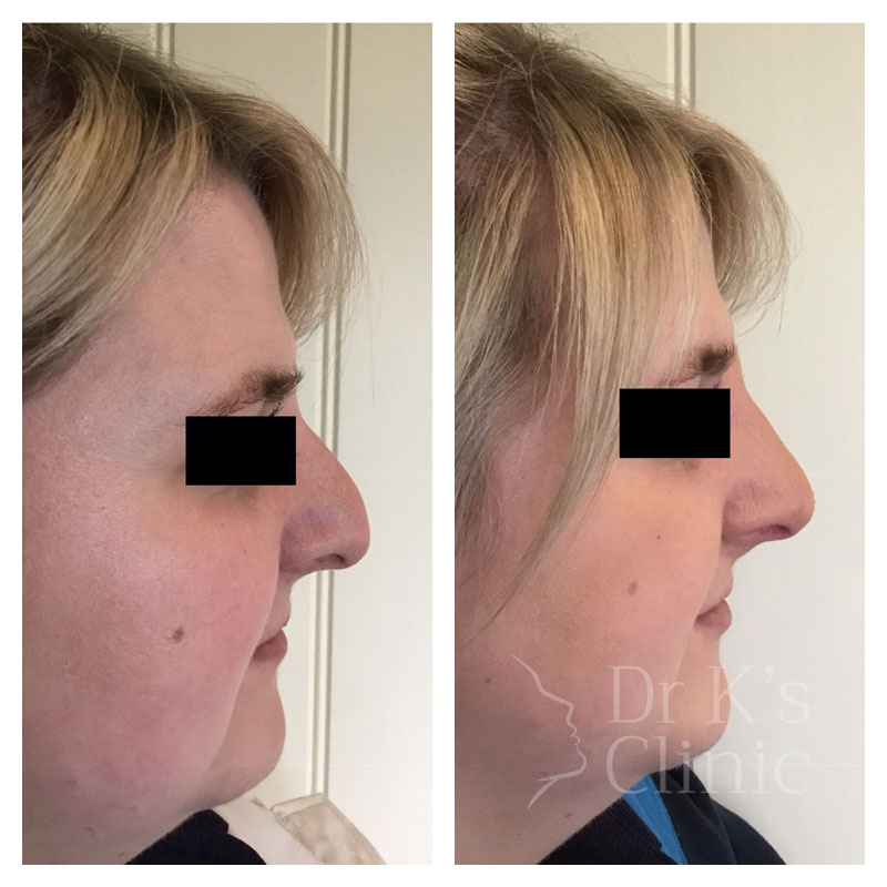 Before and after photo of dermal HA fillers