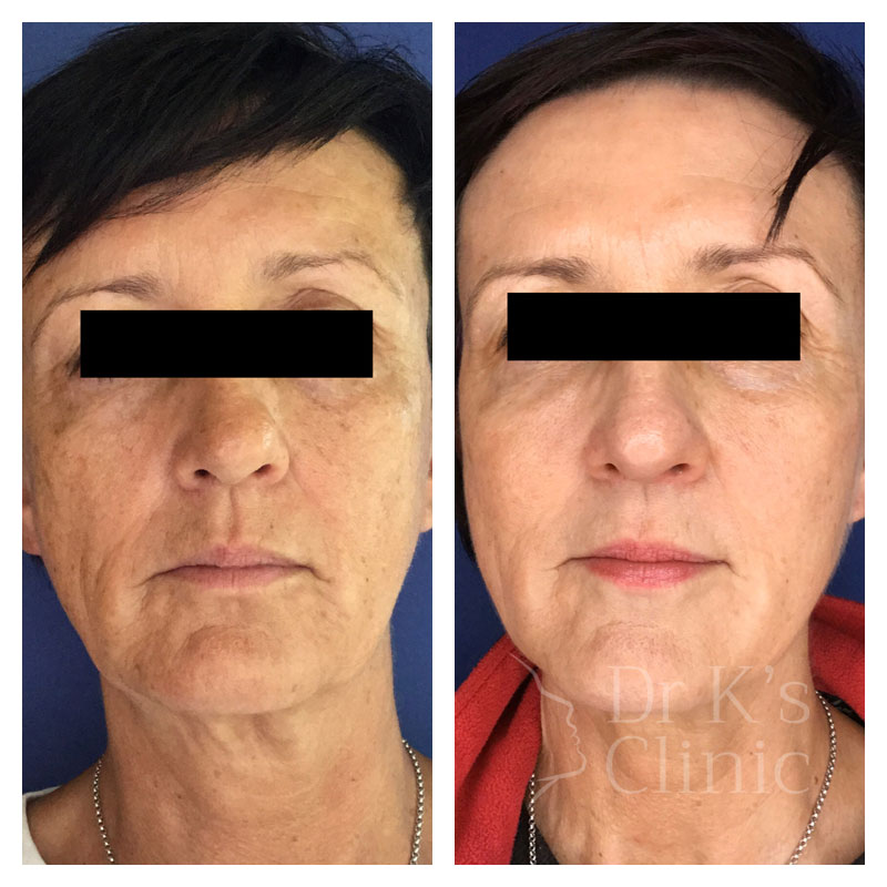 Before and after photo of liquid facelift