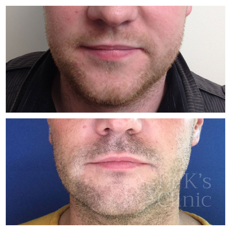 Before and after photo of liquid facelift