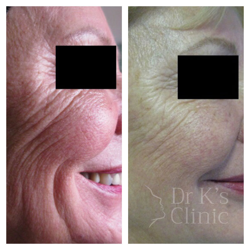 Before and after photo of dermal bio-stimulators