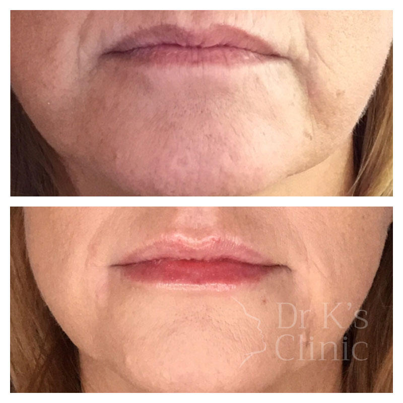 Before and after photo of dermal HA fillers