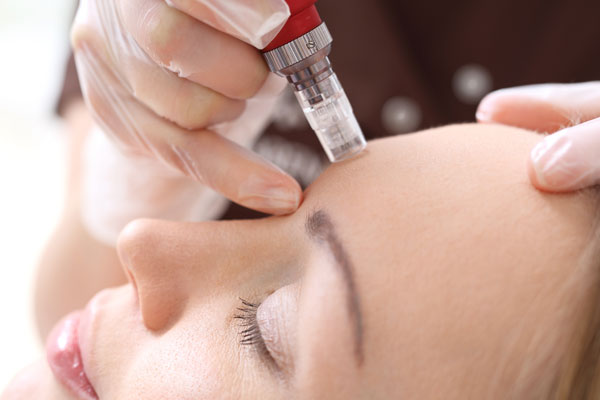 Medical Microneedling & Mesotherapy treatment in Chester