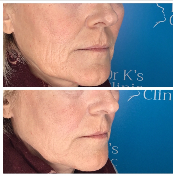 Cheek wrinkle treatment