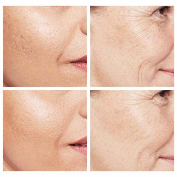 Skin boosters