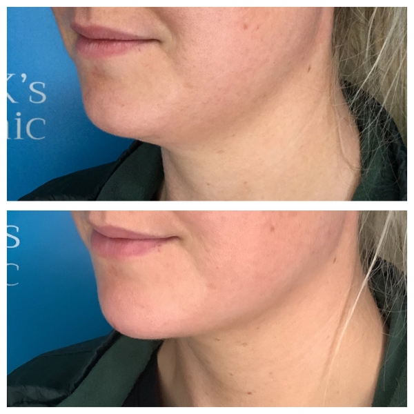 Aqualyx the fat dissolving treatment for double chins