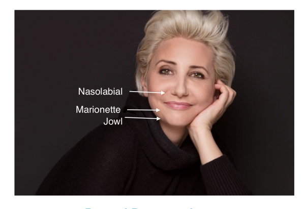 Bothered by these lines, folds and jowls? Sometimes called nasolabial lines/folds and marionettes. Botox, dermal fillers, bio-stimulators, PDO thread treatments can help.