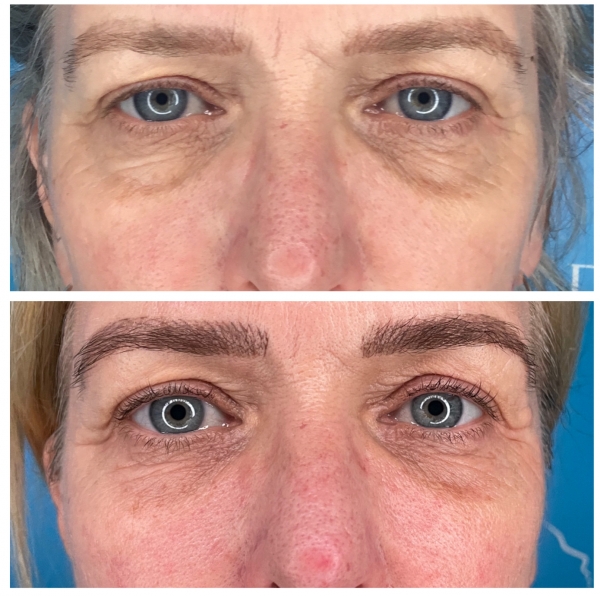 Don’t like the thought of Botox or dermal filler? Here’s a natural alternative: Platelet Rich Fibrin (PRF) treatment.
