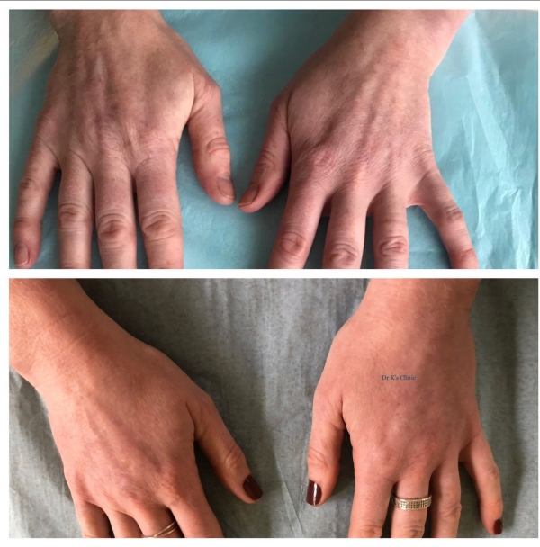 Ellansé and treatments for ageing hands