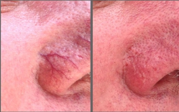 How to treat small vessels on the face.