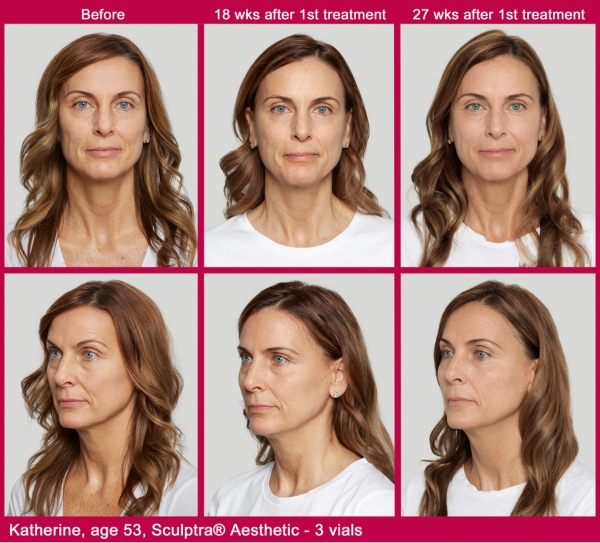 What is Sculptra?