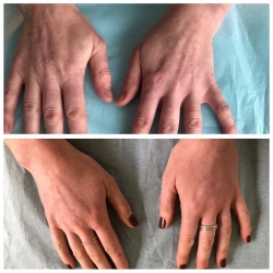 Are you looking for treatment for your aged hands?