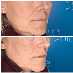 Cheek wrinkle treatment