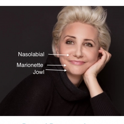 Bothered by these lines, folds and jowls? Sometimes called nasolabial lines/folds and marionettes. Botox, dermal fillers, bio-stimulators, PDO thread treatments can help.