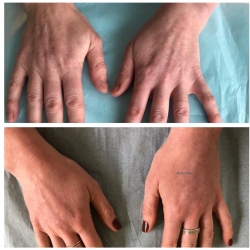 Ellansé and treatments for ageing hands