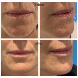 Treatments for lip lines