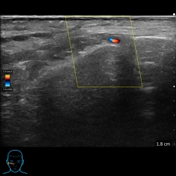 Ultrasound use prior to injecting fillers in aesthetics