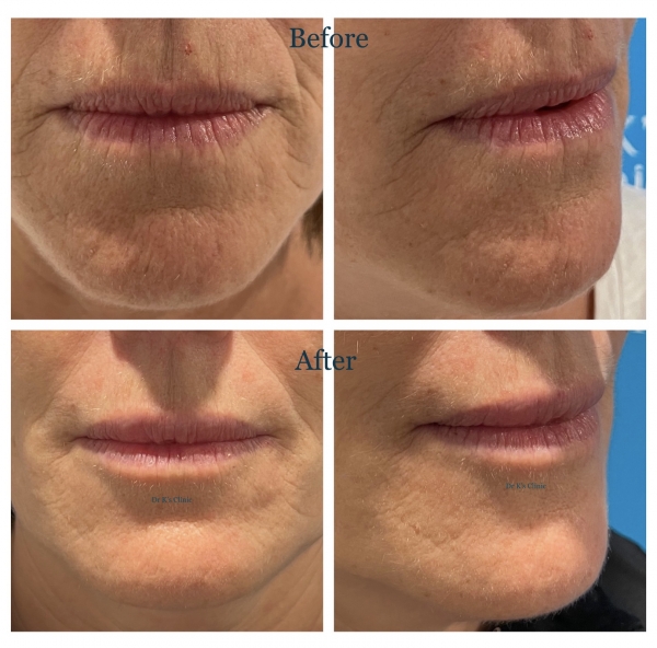 Treatments for lip lines