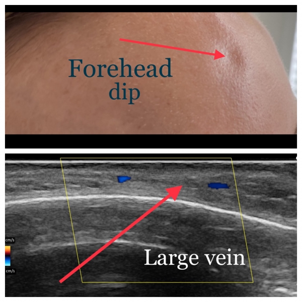 Ultrasound use in aesthetics