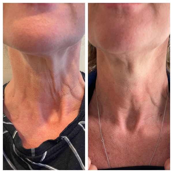 WANT A TREATMENT FOR SAGGING, LOOSE AND CREPEY SKIN OF THE NECK?